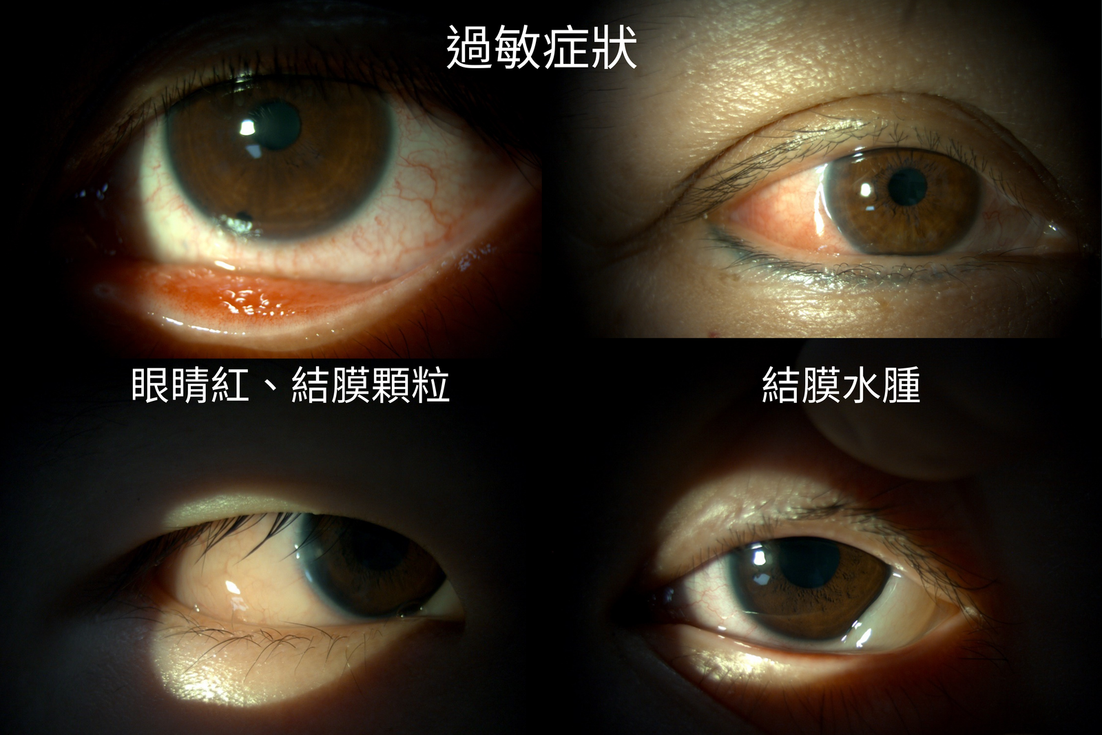 眼睛又癢了嗎？一直眨眼一直想揉怎麼辦？ - 台大． 新竹竹北大學．院長何奕瑢醫師, image size:1600x1067